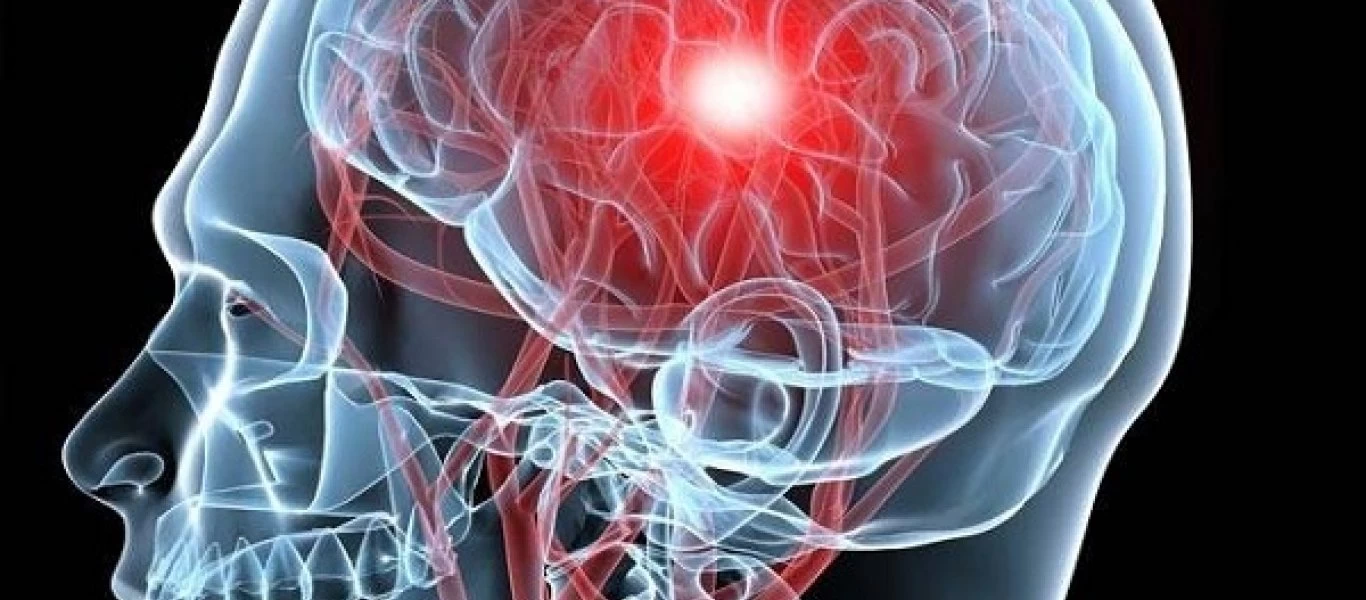 Ανεύρυσμα στο κεφάλι: Με αυτόν τον τρόπο θα αναγνωρίσετε τη ρήξη πριν να είναι πολύ αργά